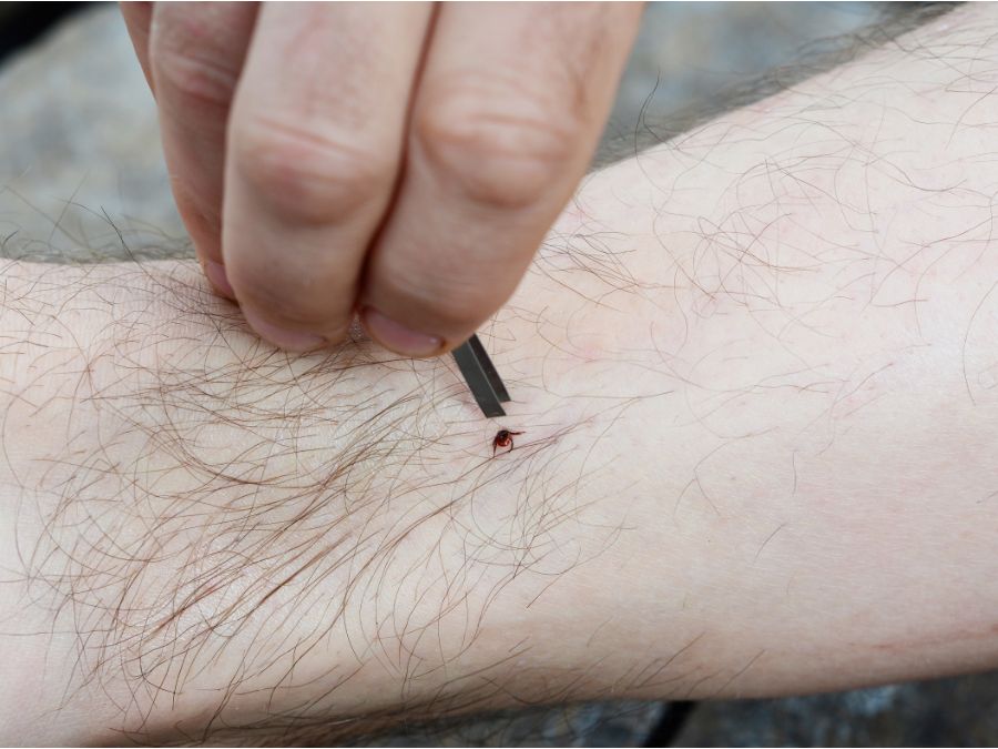A person removing a tick from their leg using tweezers. 