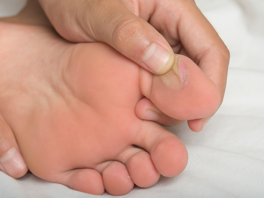 A close up of a foot with a toe that has blisters on it.