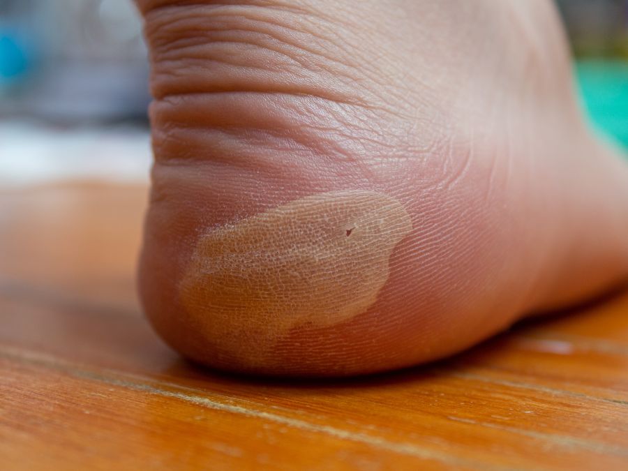A blister on the back of an ankle.